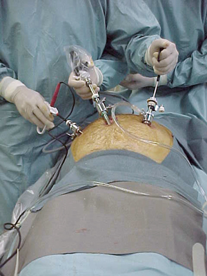 O que pode dar errado na Cirurgia de Hérnia Inguinal? • Café Cirúrgico