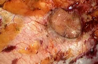 Visão interna (dentro do abdome) da hérnia